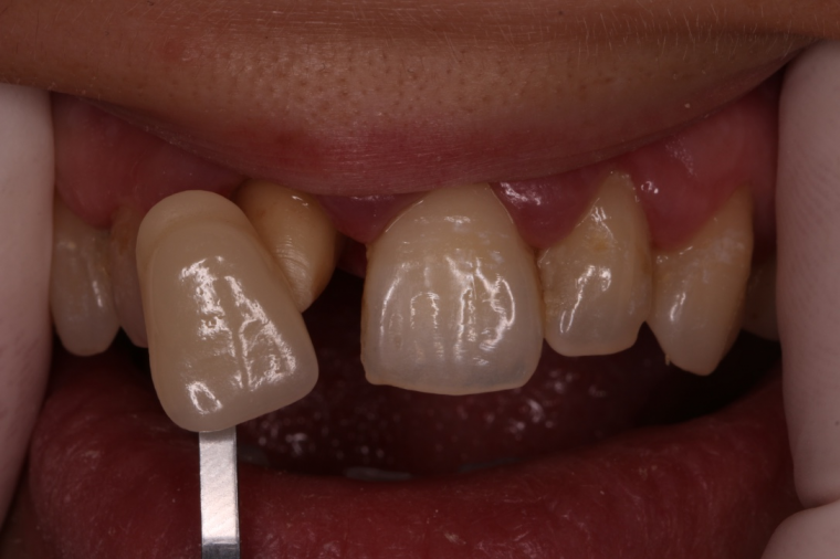 EMax dental crown