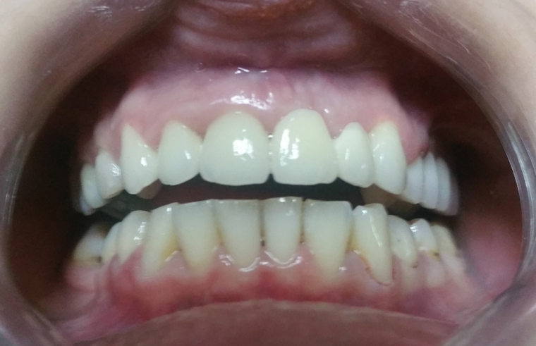 Fixed ceramic and metal-ceramic crowns