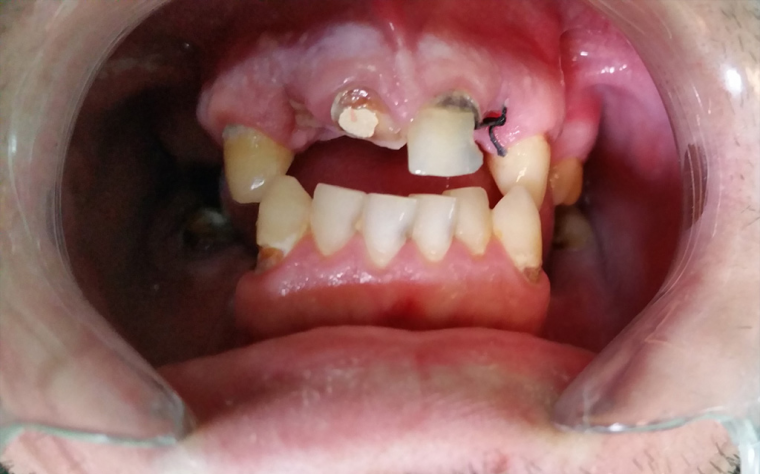 Malocclusions and metal-ceramic crowns