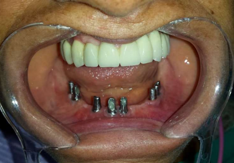 Implants and metal-ceramic fixed bridge