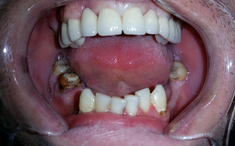 Malocclusions and metal-ceramic crowns