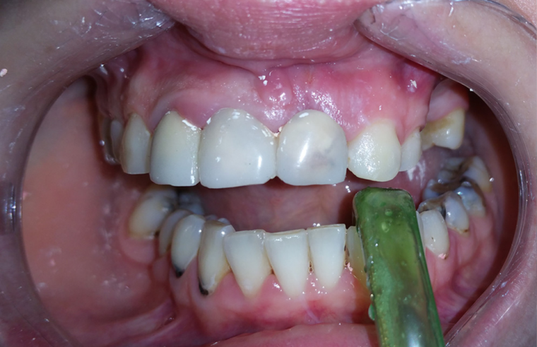 Fixed ceramic and metal-ceramic crowns