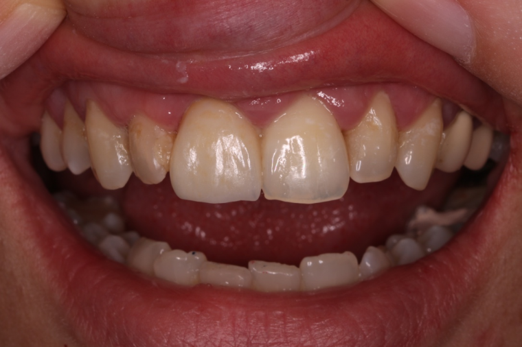 EMax dental crown