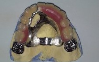 Upper skeletal prosthesis with telescopic systems and with 2 ACK - Clinical case 20, Photo 2