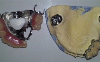 Upper skeletal prosthesis with telescopic systems and with 2 ACK - Clinical case 20, Photo 5