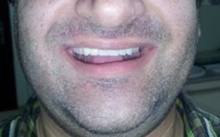 Upper skeletal prosthesis with telescopic systems and with 2 ACK - Clinical case 20, Photo 10