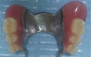 Upper and lower skeletal prosthesis with telescopic systems - Clinical case 21, Photo 3