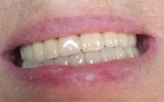 Upper and lower skeletal prosthesis with telescopic systems - Clinical case 21, Photo 8