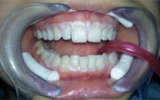 Professional whitening - Clinical case 22, Photo 1