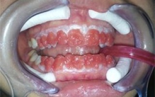 Professional whitening - Clinical case 22, Photo 2