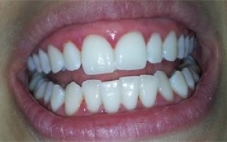 Professional whitening - Clinical case 22, Photo 3