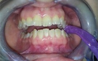 Professional whitening - Clinical case 12, Photo 1