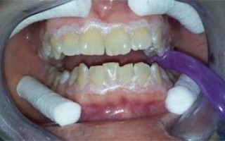 Professional whitening - Clinical case 12, Photo 2