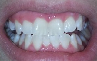Professional whitening - Clinical case 12, Photo 3