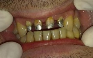 Individual metal-porcelain dental crowns - Clinical case 3, Photo 1