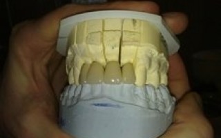 Individual metal-porcelain dental crowns - Clinical case 3, Photo 2