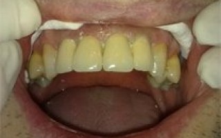 Individual metal-porcelain dental crowns - Clinical case 3, Photo 3