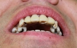 Metal-porcelain dental crowns Vita - Clinical case 4, Photo 1