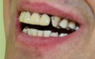 Metal-porcelain dental crowns Vita - Clinical case 4, Photo 2