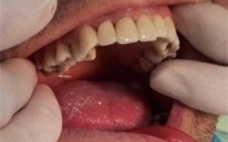 Metal-porcelain dental crowns Vita - Clinical case 4, Photo 3