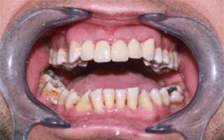 Metal-porcelain dental crowns Vita - Clinical case 4, Photo 4