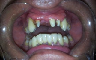 Dental bridges - Clinical case 23, Photo 1