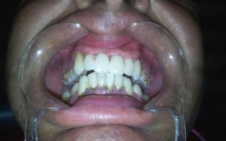Dental bridges - Clinical case 23, Photo 2
