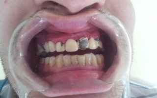 Vita porcelain dental bridge on metallic structure - Clinical case 24, Photo 1