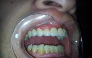 Vita porcelain dental bridge on metallic structure - Clinical case 24, Photo 2