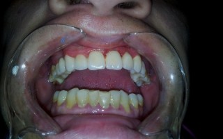Vita porcelain dental bridge on metallic structure - Clinical case 24, Photo 3