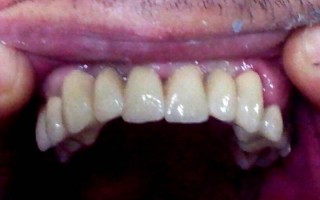 Vita metal-ceramic bridge - Clinical case 5, Photo 2