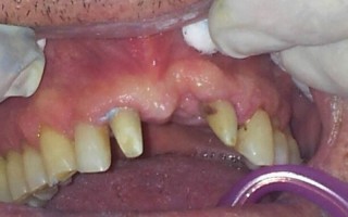Frontal edentulism - Clinical case 25, Photo 1