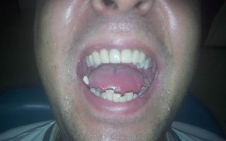 Zirconia fixed dental bridge - Clinical case 11, Photo 2