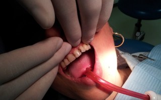 Composite filling restorations - Clinical case 2, Photo 1