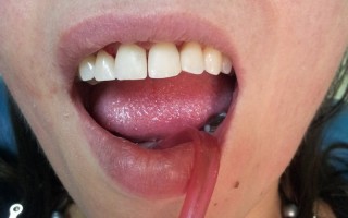 Composite filling restorations - Clinical case 2, Photo 2