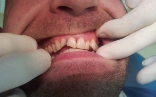 Composite filling restorations - Clinical case 9, Photo 1