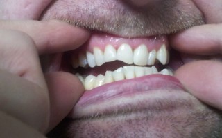 Composite filling restorations - Clinical case 9, Photo 2