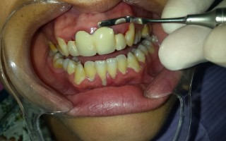 Restoring treatments and metal-porcelain crown - Clinical case 26, Photo 1