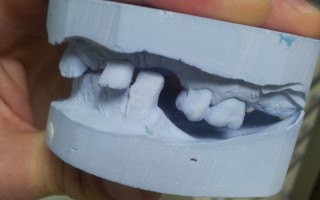 Total upper and lower bridges - Clinical case 1, Photo 1