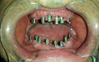 Full bi-maxillary edentulism - Clinical case 18, Photo 1