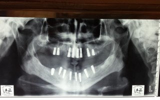 Full bi-maxillary edentulism - Clinical case 18, Photo 2