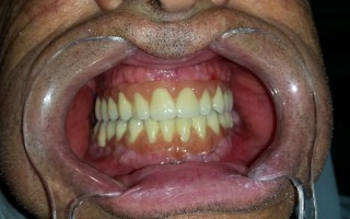 Full bi-maxillary edentulism - Clinical case 18, Photo 3