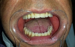 Full bi-maxillary edentulism - Clinical case 18, Photo 4