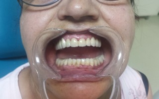 Upper metal-ceramic bridge and lower skeletal one - Clinical case 16, Photo 1