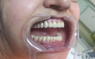 Upper metal-ceramic bridge and lower skeletal one - Clinical case 16, Photo 2