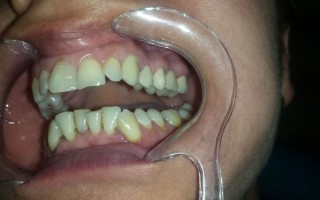 Metal-ceramic dental bridge - Clinical case 19, Photo 2