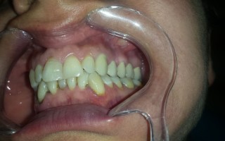 Metal-ceramic dental bridge - Clinical case 19, Photo 3