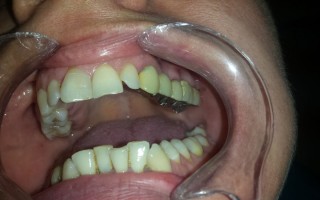Metal-ceramic dental bridge - Clinical case 19, Photo 4