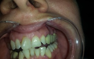 Metal-ceramic dental bridge - Clinical case 19, Photo 1