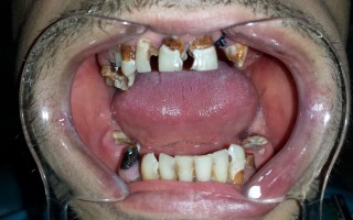 Metal-ceramic fixed bridge prosthesis - Clinical case 14, Photo 1